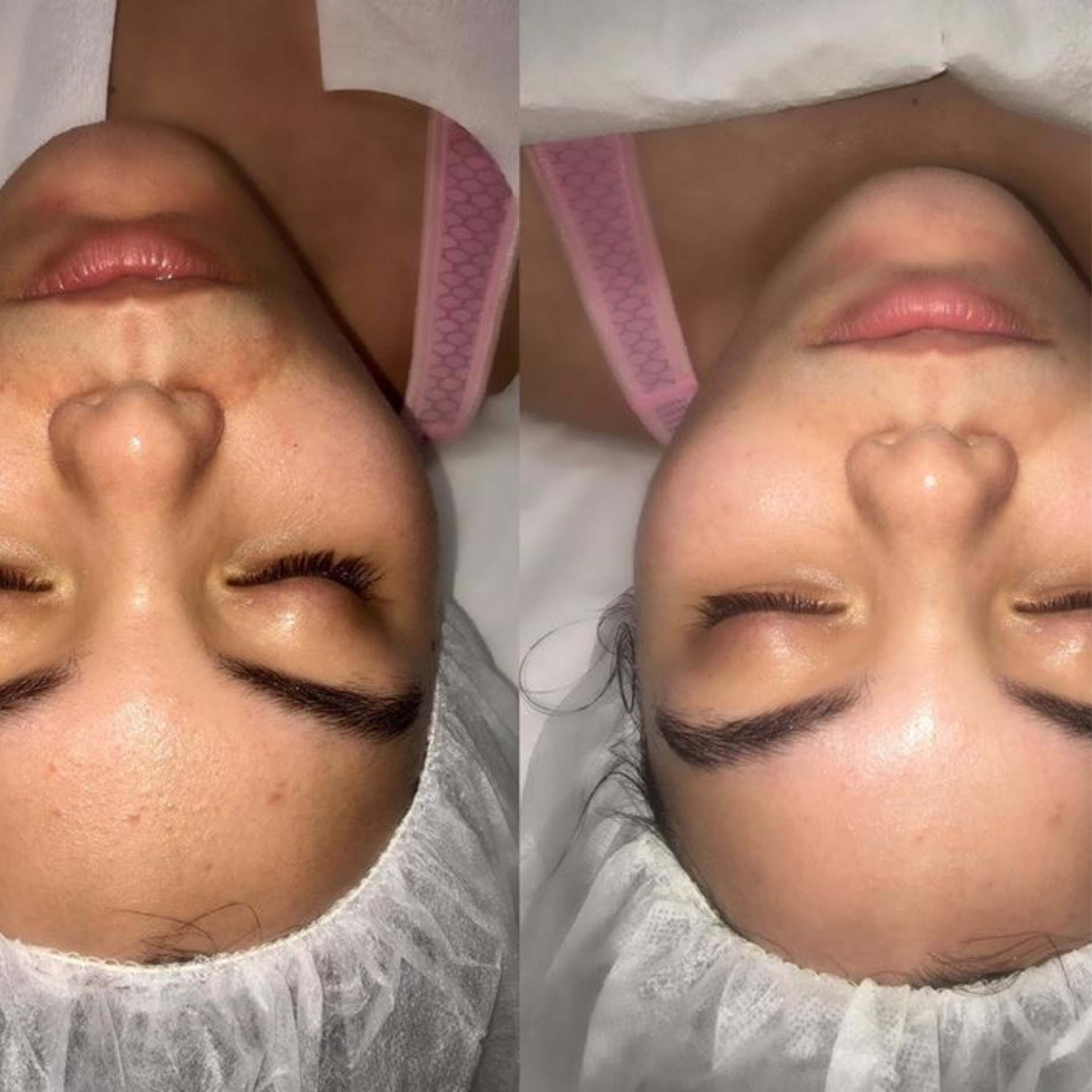 LIB-COSMETOLOGY - Facial treatment (Before-After) [KGV3S]